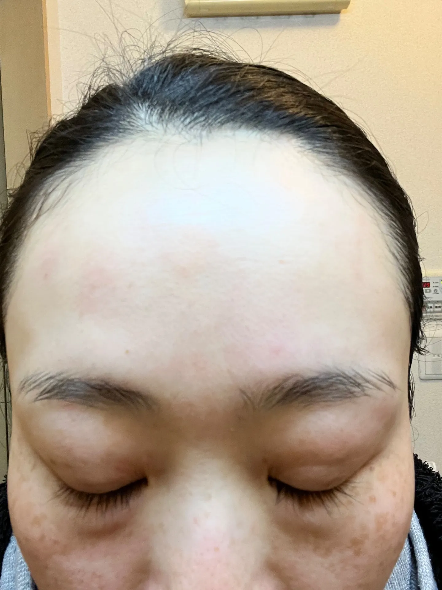 シュガーリング後の赤みって？知っておきたいヒスタミン反応